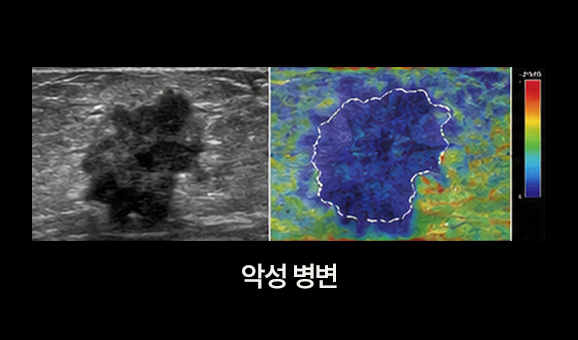 악성 병변