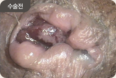 수술 전