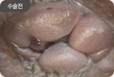 수술 전