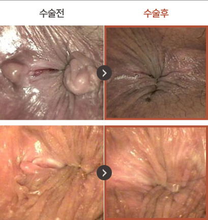 수술전 / 수술후