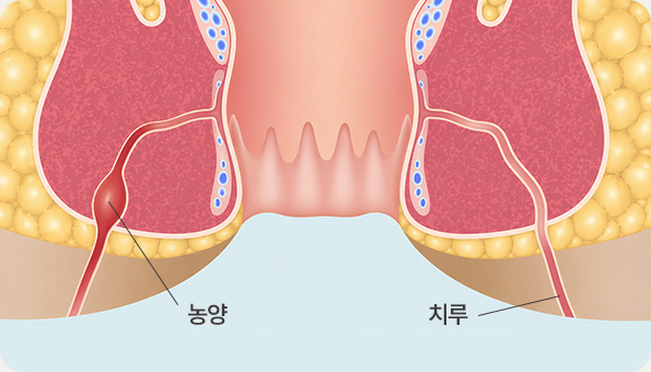 농양 / 치루